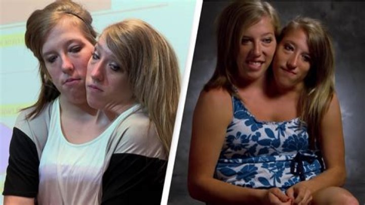 Amber and Brittany Conjoined Twins: The Extraordinary Journey of Resilience and Hope