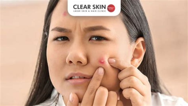 Anatomy of a Blind Pimple: Understanding Causes, Treatments, and Prevention