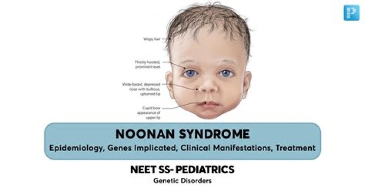 Ben Stiller and Noonan Syndrome: Understanding the Connection