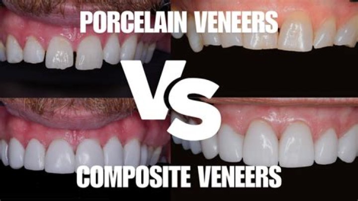 Can You Get Veneers with Dental Insurance Coverage?