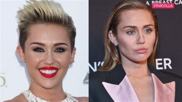 Celebrity Buccal Fat Removal Before and After: Unveiling the Transformation