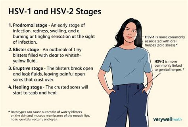 Comprehensive Guide to HSV 2 IGG Positive Treatment: Understanding, Managing, and Healing