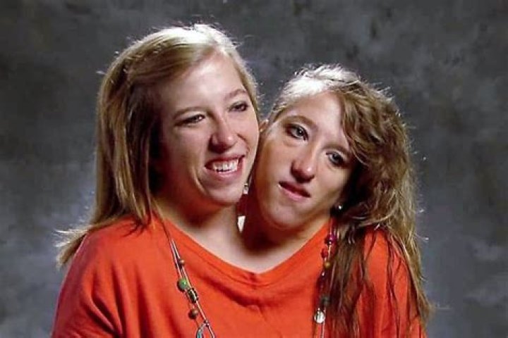 Conjoined Twins Abby and Brittany: Inspiring Lives and Extraordinary Journey