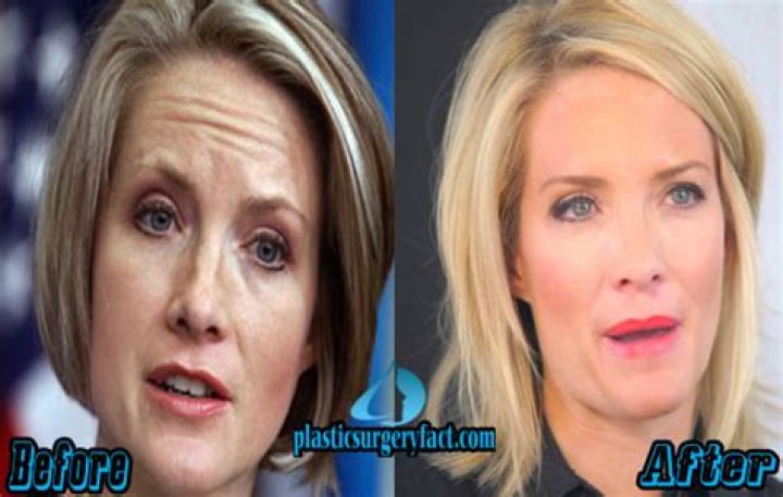 Dana Perino Nose Surgery: A Comprehensive Guide to Understanding the Procedure and Its Implications