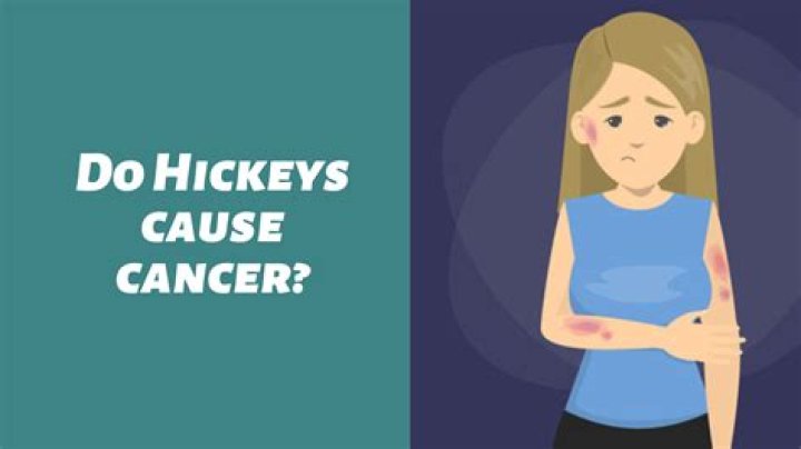 Do Hickeys Cause Cancer? Debunking the Myth and Understanding the Truth