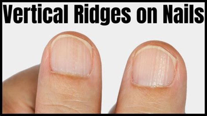 Nail Vertical Ridges: What They Are, Causes, Treatments, and Prevention