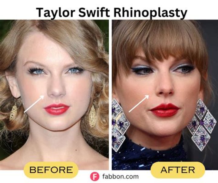 Taylor Swift Plastic Surgery: Exploring the Truth Behind the Rumors
