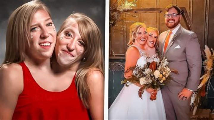 The Remarkable Journey of Conjoined Twins Abby and Brittany: Love, Life, and Marriage