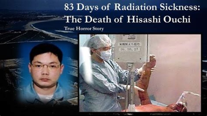 Understanding Hisashi Ouchi Skin: The Impact of Radiation Exposure