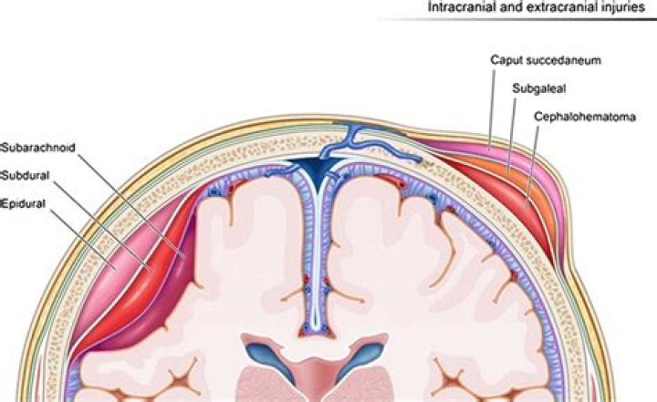 Understanding Subgaleal Bleeding: Causes, Symptoms, Diagnosis, and Treatment