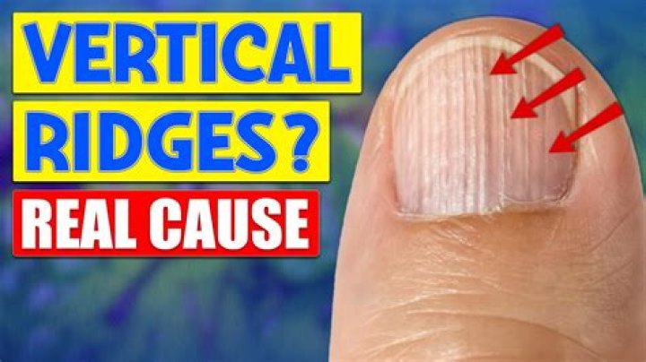 Understanding Vertical Ridged Nails and Thyroid: A Comprehensive Guide